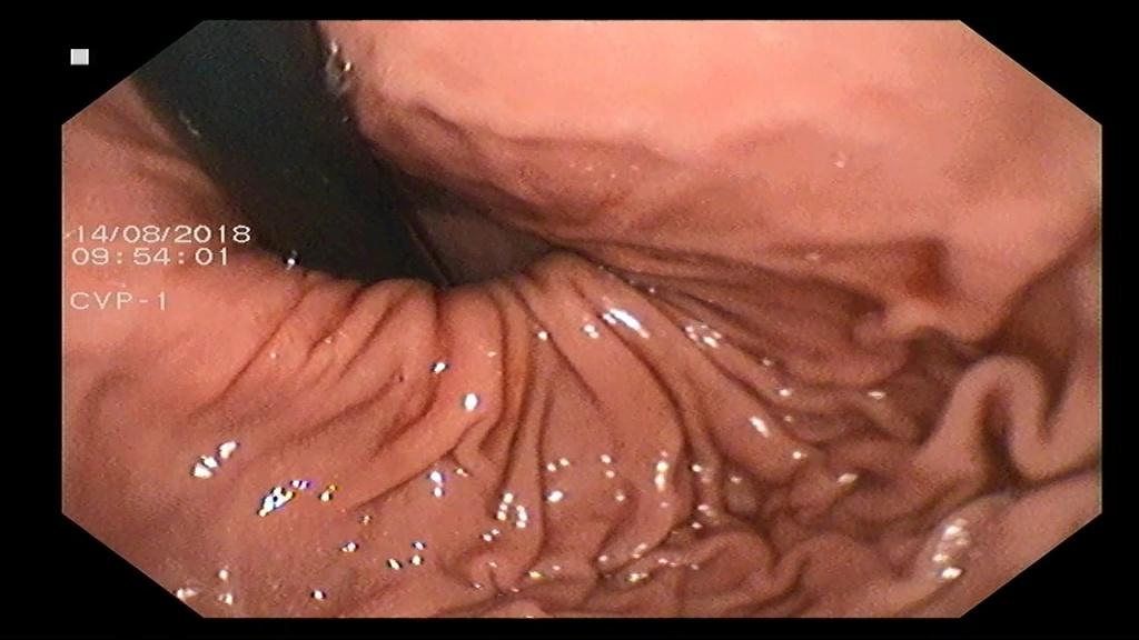 Аксиальная фиксированная кариофундальная грыжа пищеводного отверстия диафрагмы. Атлас эндоскопических изображений endoatlas